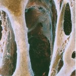 osteoporosis