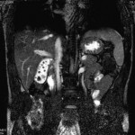 MRCP