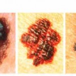 melanoma