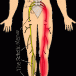 Sciatica_Full_Figure1