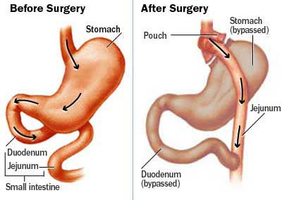 Bypass gastrico utile per smettere di bere alcolici