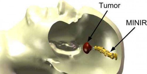 Robot-lombrichi per i tumori cerebrali