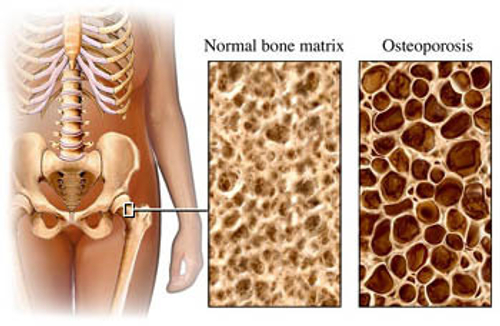 osteoporosi maschile cause sintomi