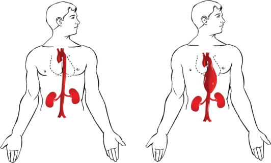 aneurisma aortico addominale sintomi cause