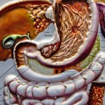 pancreatite acuta