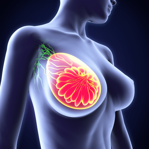 tumore seno cause fattori di rischio