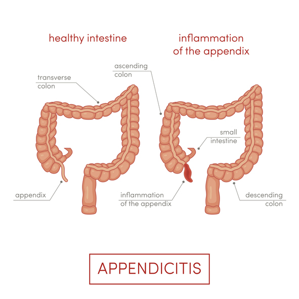 appendicite sintomi cause cure