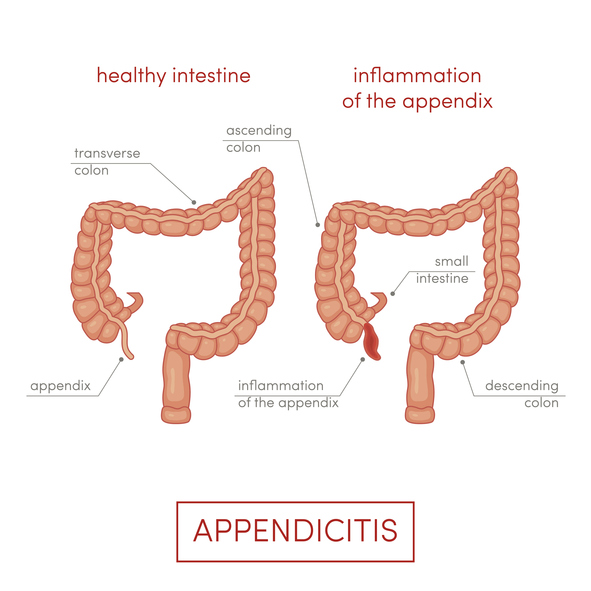 appendicite