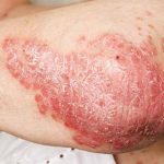 psoriasi